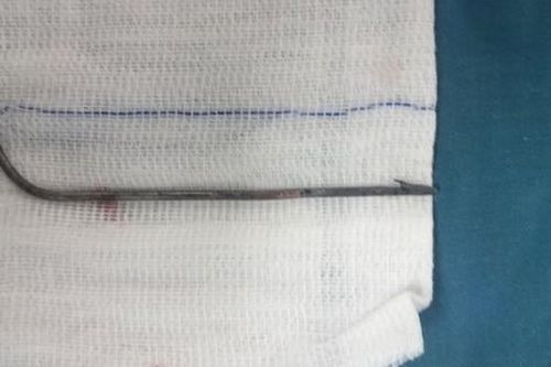 Mũi tên bắn cá dài 7cm đâm xuyên vào tủy nam thanh niên