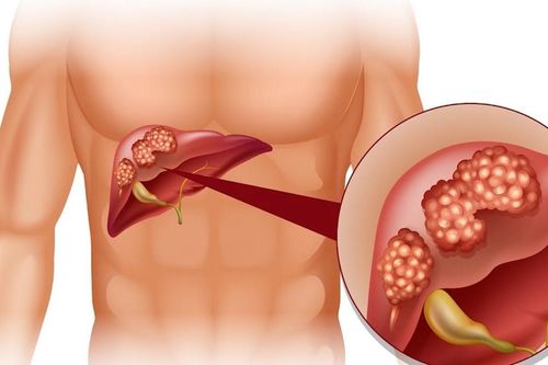 Chế độ ăn uống cho người bị viêm gan C