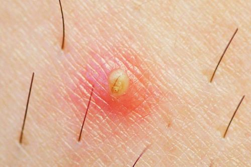 Cách chữa lông mọc ngược đơn giản mà hiệu quả vô cùng