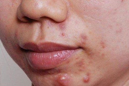 Các chất bổ sung hỗ trợ điều trị mụn trứng cá