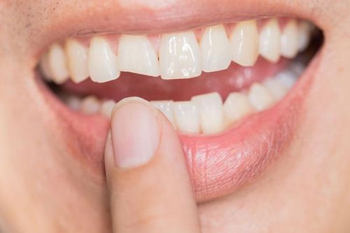 Mảng bám trên răng hình thành như thế nào?