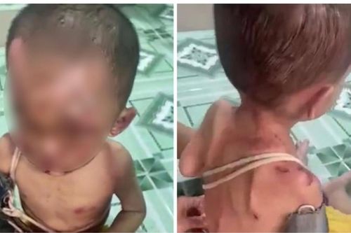 Xót xa hình ảnh bé trai hơn 1 tuổi chằng chịt vết thương nghi bị bạo hành