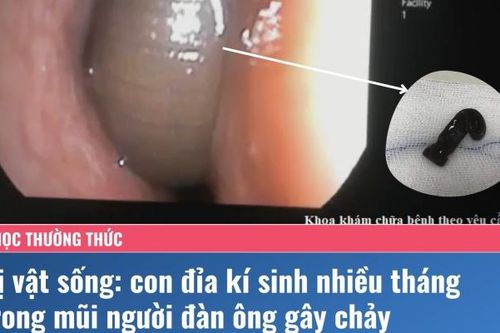 Đỉa sống trong mũi hơn 3 tháng, được chẩn đoán viêm xoang, uống kháng sinh kéo dài