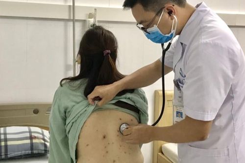 Trời nồm ẩm, bác sĩ cảnh báo biến chứng nguy hiểm của bệnh thủy đậu