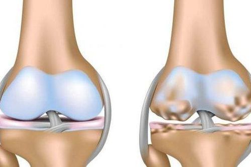 Vì sao tràn dịch khớp gối hay bị tái lại và cách hạn chế
