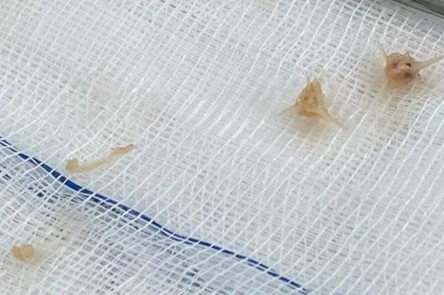 Bé gái 10 tháng tuổi nguy kịch do mảnh xương lươn