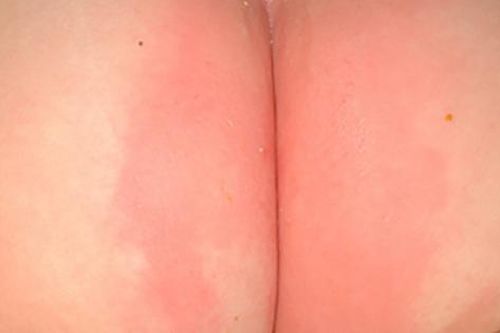 Hăm tã, cách điều trị và dự phòng