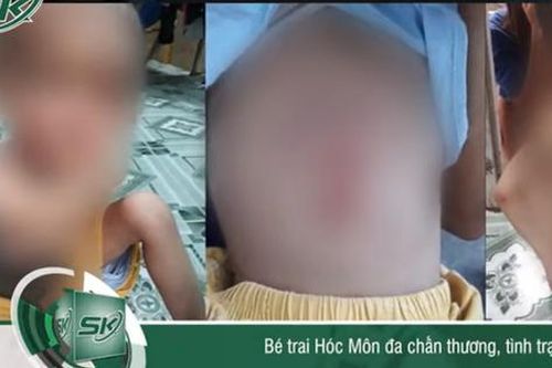 Bé trai Hóc Môn chi chít vết thương: 'Hiện tại bé phải hồi sức, chưa nói trước được điều gì'