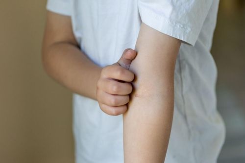 Làm gì khi con bạn mắc bệnh ghẻ?