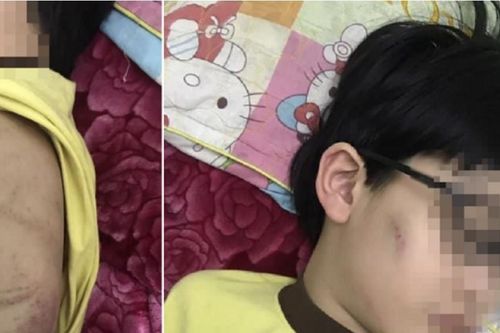 Thông tin bé trai bị mẹ bạo hành phải nhập viện ở Quảng Ninh là không đúng