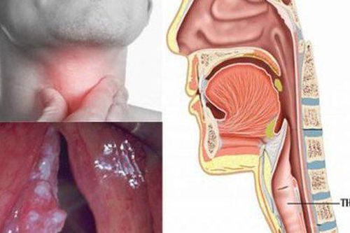 Khàn tiếng, mất tiếng người đàn ông 59 tuổi bất ngờ được chẩn đoán ung thư thanh quản