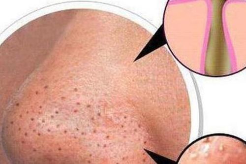 Các biện pháp giúp loại bỏ mụn đầu đen