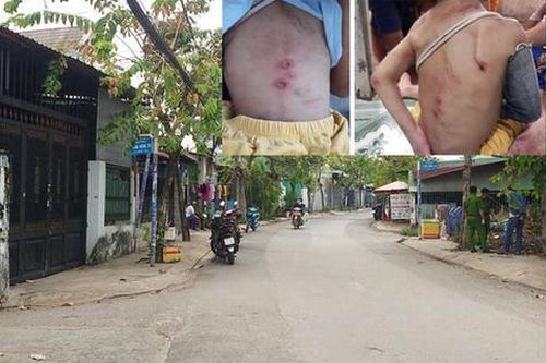 Vụ bé trai ở Hóc Môn chi chít vết thương: Xem xét cho nạn nhân tách khỏi cha mẹ