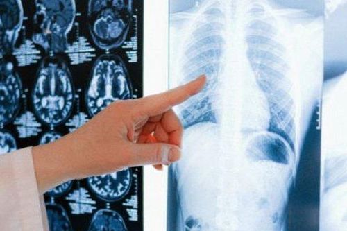 Bạn biết gì về ung thư trung biểu mô – căn bệnh ung thư nguy hiểm nhất?