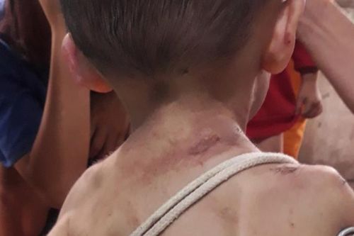 Vụ bé trai ở TP.HCM nghi bị bạo hành: Trẻ chưa thể xuất viện