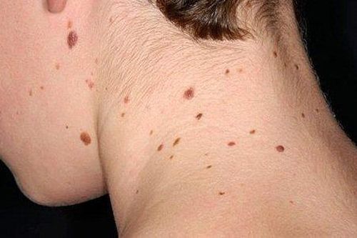 Đột phá lớn trong nghiên cứu về phương pháp điều trị ung thư da