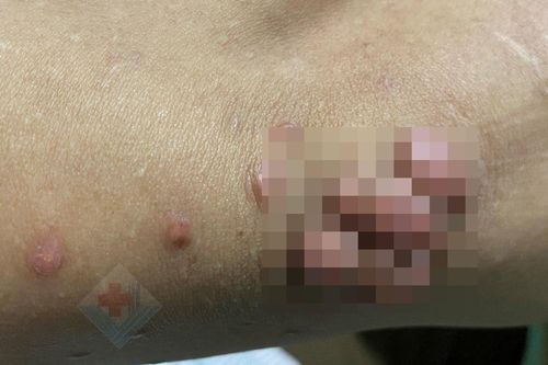 Người đàn ông mọc nhiều khối u trên cơ thể