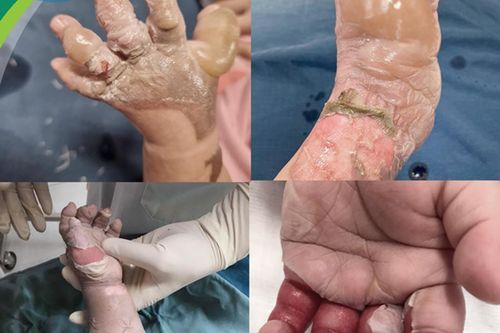 Cách xử trí đúng khi trẻ bị bỏng nhiệt