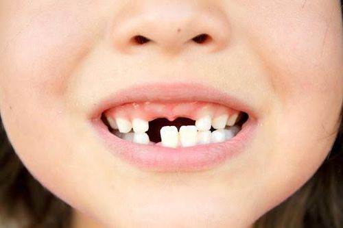 Những bệnh răng miệng trẻ nhỏ thường hay gặp