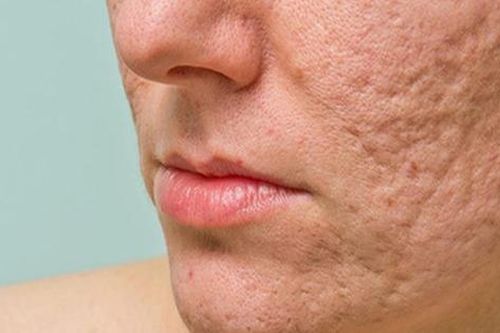 Cách chăm sóc và điều trị sẹo rỗ