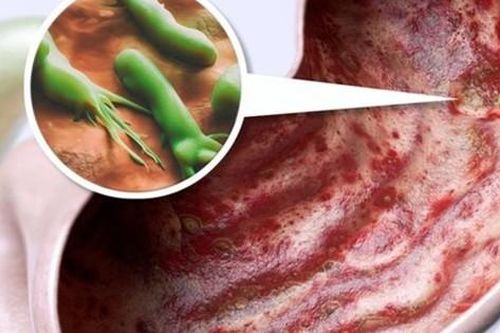Thuốc chẹn H2 trị viêm loét dạ dày do vi khuẩn H.pylori, cảnh giác với tác dụng phụ