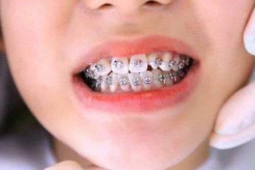 Niềng răng có phải kiêng ăn uống gì không?