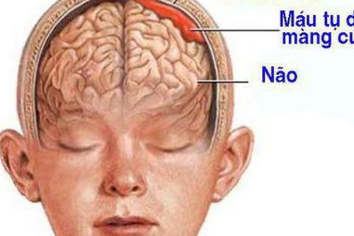 Bị ngã sau 2 tháng mới phát hiện bị tụ máu dưới màng cứng, bệnh nhân phải phẫu thuật khẩn cấp