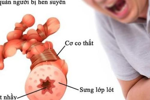 Mắc chồng chéo hen COPD, chữa thế nào?