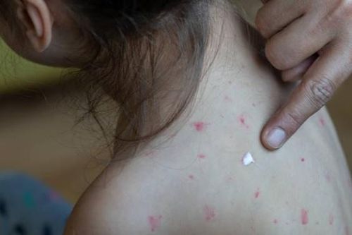 Tại sao chích ngừa sởi rồi mà vẫn mắc bệnh?