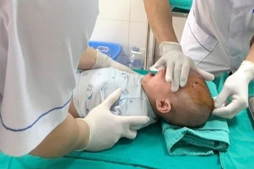 Bé trai bị vật nhọn đâm vào thóp