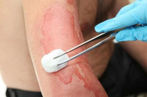 Chuyên gia cảnh báo bỏng lửa cồn vào mùa hè