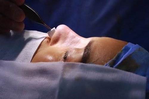 Nguyên nhân sau nâng mũi cấu trúc bị co rút và vẹo lệch