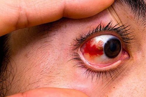 Nhận biết các bệnh lý võng mạc nguy hiểm