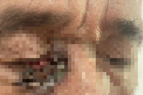 Chủ quan khi xuất hiện nốt ruồi, người đàn ông đi khám mới tả hỏa mắc ung thư da