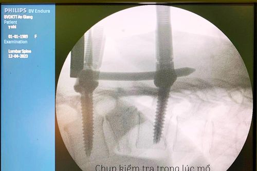 Bệnh viện Đa khoa Trung tâm An Giang triển khai kỹ thuật phẫu thuật cột sống xâm lấn tối thiểu (MISS)