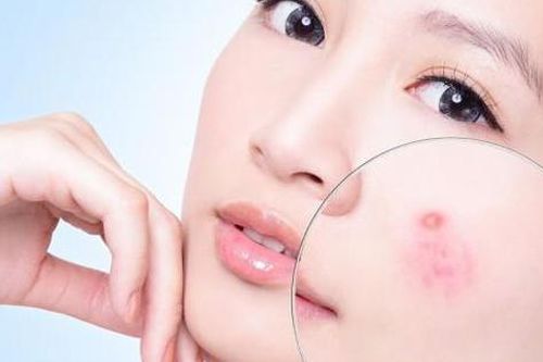 Bài thuốc trị mụn trứng cá do tạng phế bị nhiệt