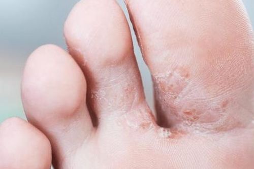 Hạn chế sự khó chịu khi mắc nấm kẽ chân