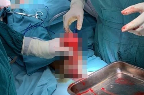 Nát nhừ 2 bàn tay vì vật liệu nổ