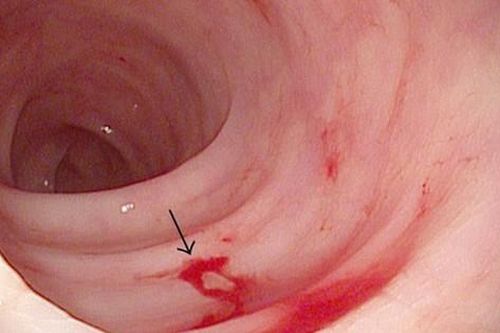 Vì sao cần dùng thuốc ức chế bơm proton trị loét dạ dày do vi khuẩn H.pylori?