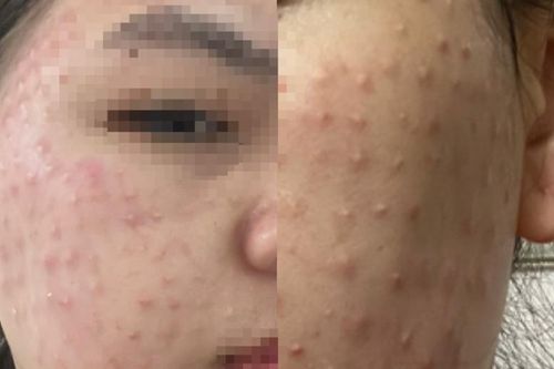 Tiêm chất làm trắng da siêu tốc, cô gái nhập viện với gương mặt chi chít mụn sần