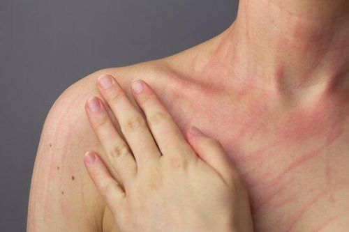 Cách kiểm soát mề đay mạn tính
