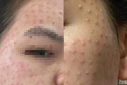 Mặt nổi u hạt chi chít như 'da cóc' sau buổi tiêm làm đẹp da miễn phí