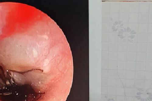 Bác sĩ phát hiện con gián còn sống trong tai bé 2 tuổi