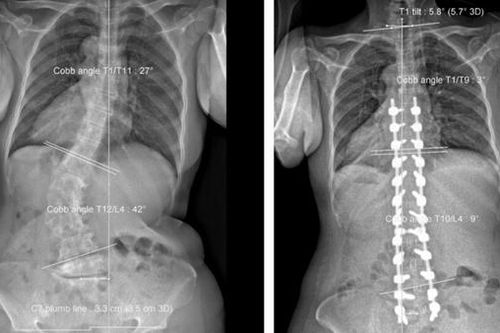 Trả lại 8cm chiều cao cho bệnh nhân sau ca mổ kéo dài hơn 7 giờ đồng hồ