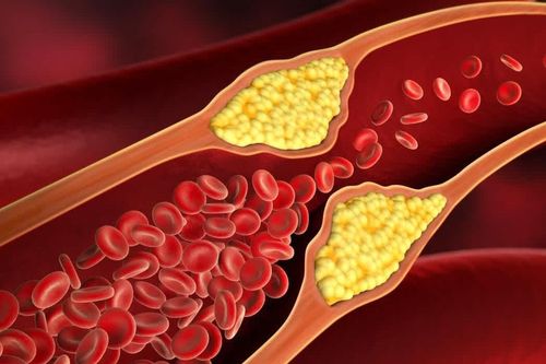 Cholesterol cao và những biến chứng khôn lường