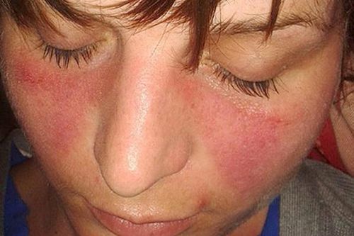 5 bệnh có thể trầm trọng hơn với nắng nóng mùa hè, phòng ngừa thế nào?