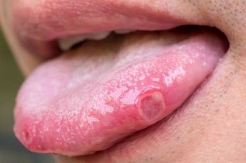 3 dấu hiệu ở lưỡi cảnh báo ung thư