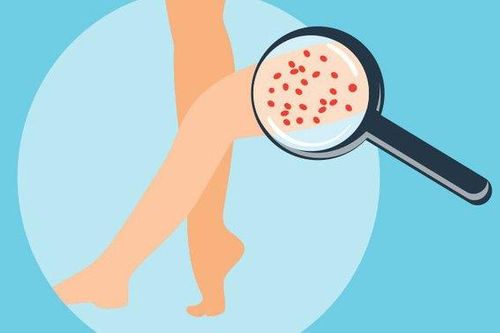 Cách khắc phục tình trạng 'chân dâu tây' giúp bạn tự tin đón hè