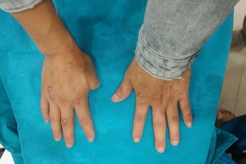 Người đàn ông được ghép ngón tay từ ngón chân sau 10 năm bị tai nạn