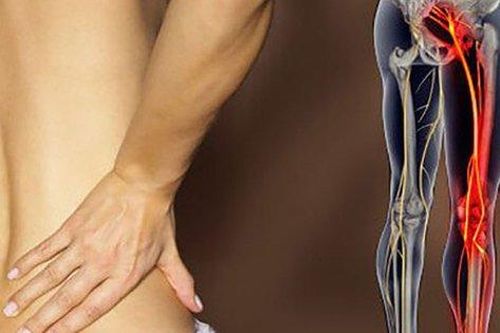 Có nên phẫu thuật khi bị đau thần kinh tọa?